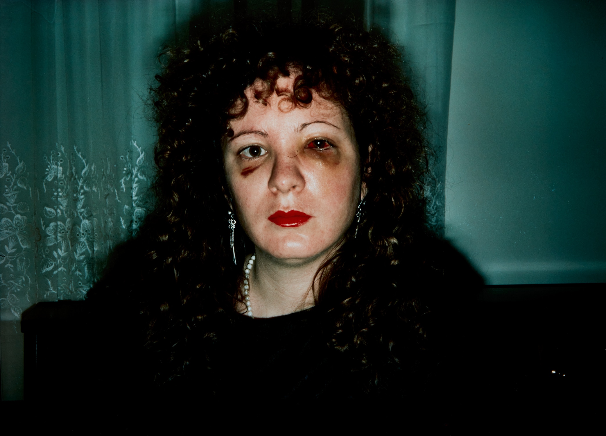 Nan Goldin — Nan after being battered