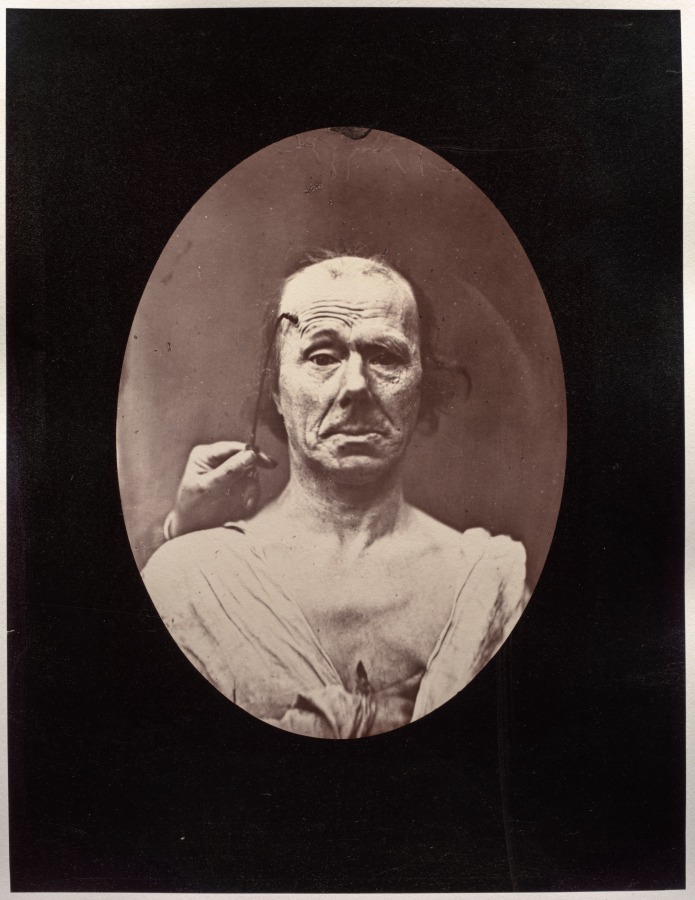 Guillaume-Benjamin-Amand Duchenne — Figure 7: Étude du méchanisme et de l'expression du muscle frontal chez un vieillard: à droit, attention; à gauche, repos